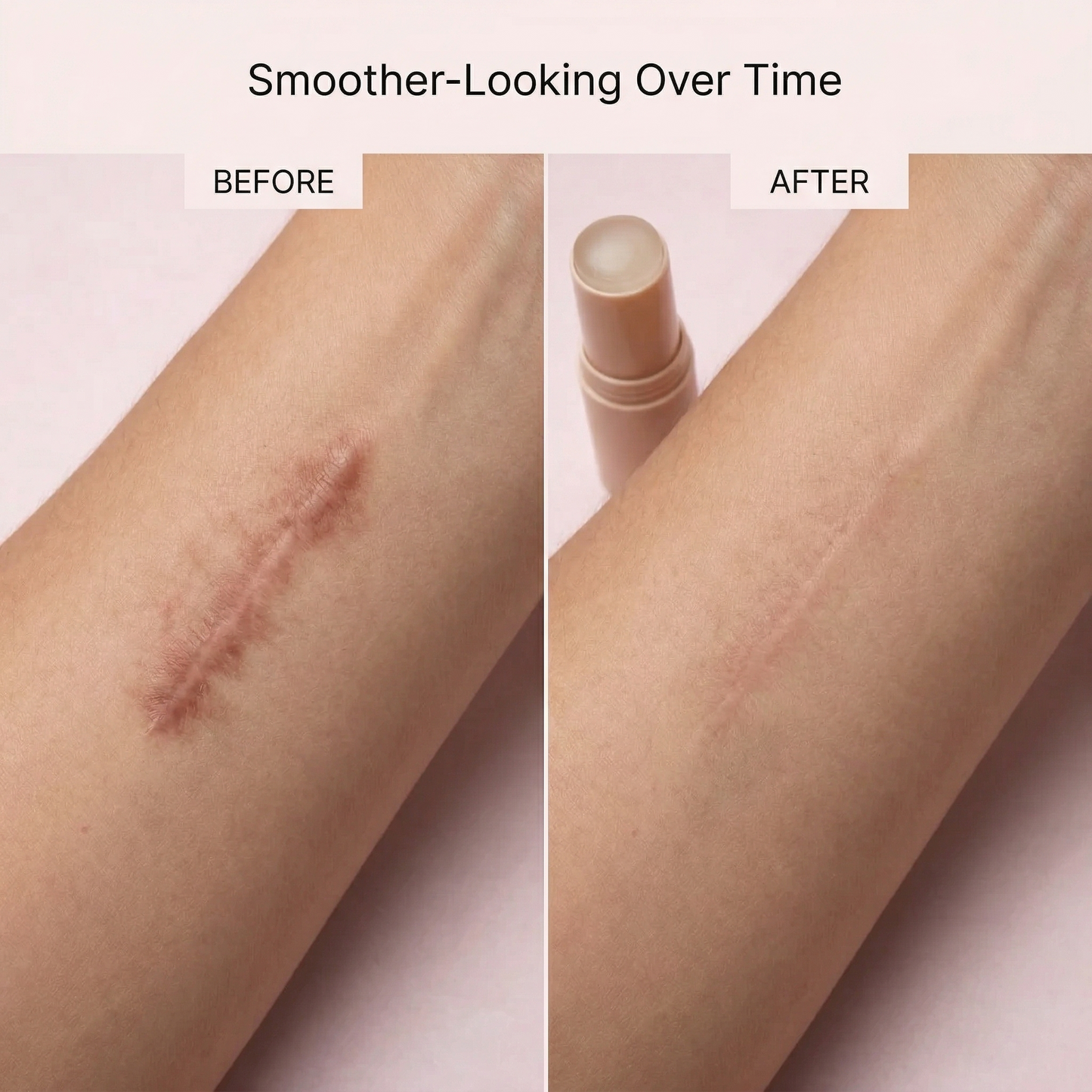 Aura ScarSmooth Stick Silicone Scar Treatment Stick Aura Beauty Devices